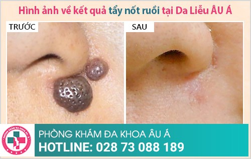 địa chỉ phá nốt ruồi