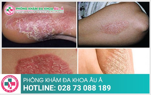 Tổng hợp những kiến thức về bệnh vảy nến - Phòng Khám Đa Khoa Âu Á