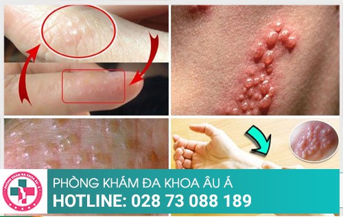 Trị mụn nước nhanh chóng, an toàn tại TP.HCM