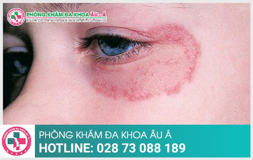 Triệu chứng của bệnh hắc lào