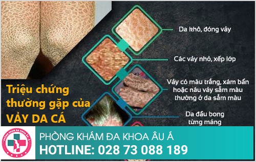 Cách trị da vảy cá ở chân hiệu quả, tiết kiệm chi phí