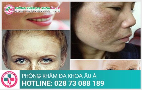 Triệu chứng và cách điều trị tàn nhang hiệu quả