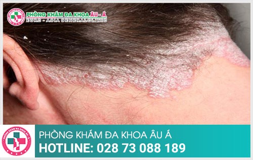 Vảy nến da đầu và những điều bạn cần lưu ý