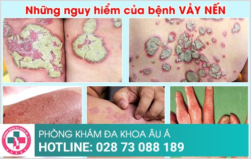 Những nguy hiểm của bệnh vảy nến