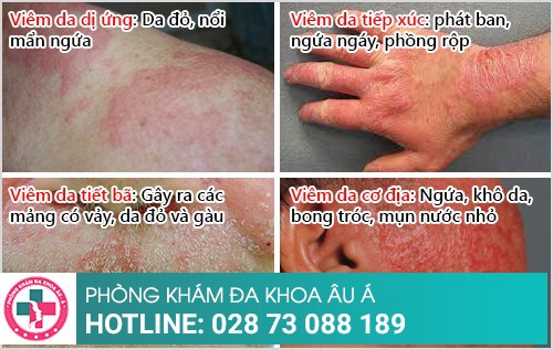 phương pháp điều trị viêm da