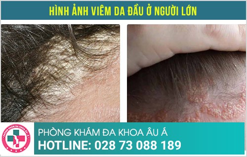 viêm da đầu