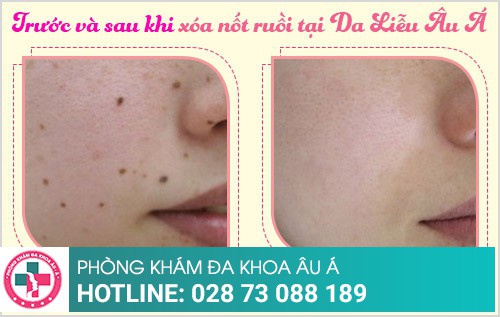 Xóa nốt ruồi bằng laser