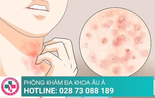 Cách trị ghẻ an toàn và hiệu quả trong 1 lần áp dụng