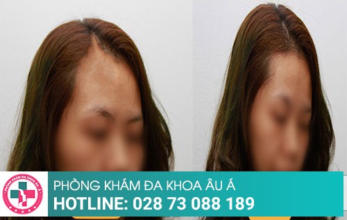 Công nghệ điều trị nấm hiệu quả chỉ sau một liệu trình