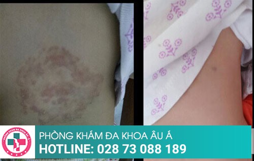 Công nghệ điều trị nấm hiệu quả chỉ sau một liệu trình