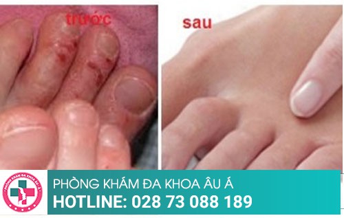 Công nghệ điều trị nấm hiệu quả chỉ sau một liệu trình