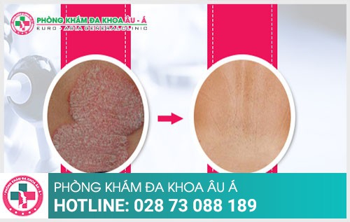 Nhận biết bệnh vảy nến qua các biểu hiện ngoài da