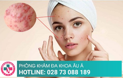 Nổi mụn ở mặt nguyên nhân và cách điều trị như thế nào?