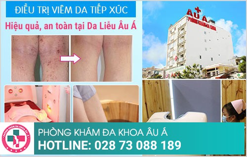 điều trị viêm da tiếp xúc điều trị viêm da tiếp xúc