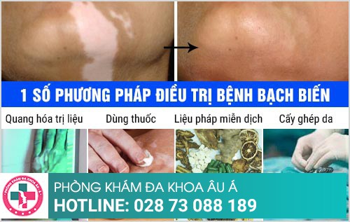 khám bạch biến khám bạch biến