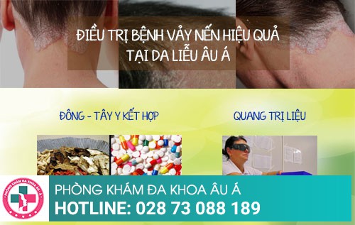 Phương pháp nào hiệu quả để thoát khỏi bệnh vảy nến