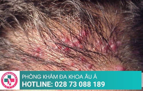 Viêm nang tóc: Nguy hại và cách điều trị an toàn