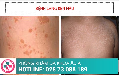 Hình ảnh bệnh lang ben đỏ - trắng – đen – nâu