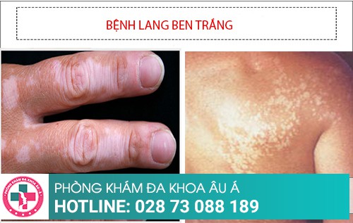 Hình ảnh bệnh lang ben đỏ - trắng – đen – nâu