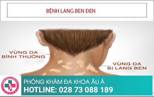 Hình ảnh bệnh lang ben đỏ - trắng – đen – nâu