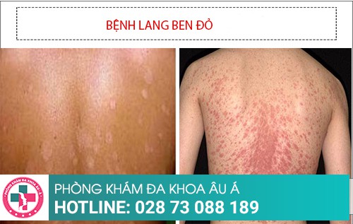 Hình ảnh bệnh lang ben đỏ - trắng – đen – nâu