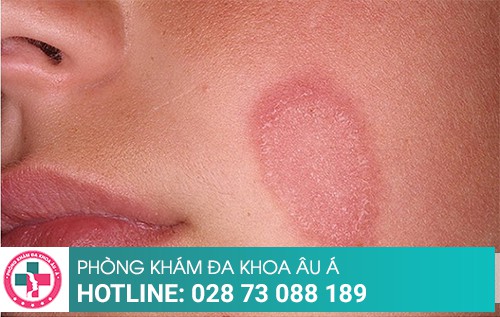 Những dấu hiệu bệnh lác đồng tiền như: vùng da có hình tam giác, khô sần, ngứa ngáy, nổi mẩn đỏ, tạo cảm giác khó chịu. Nếu bạn gặp phải những triệu chứng này, hãy đến ngay các chuyên gia để được tư vấn và điều trị sớm nhất.