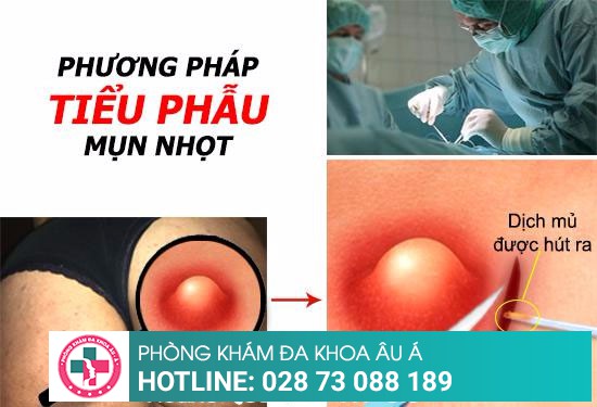 Tiểu phẫu mụn nhọt ở mông: Giải pháp nhanh chóng và an toàn