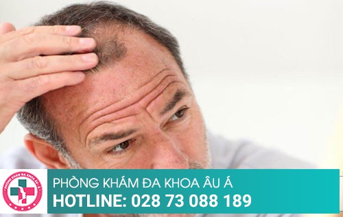 Nguyên nhân và cách điều trị bệnh rụng tóc ở nam giới  bán tóc giả nam hói  đầu