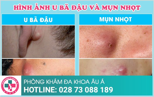 tiểu phẫu u bã đậu